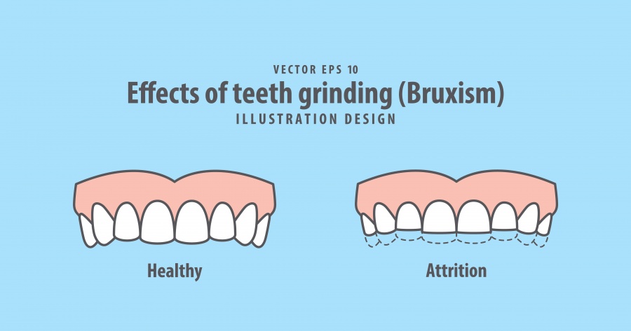 Bruxism (Teeth Grinding): A Growing Concern