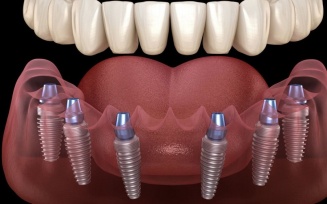 All On 6 Dental Implants Turkey